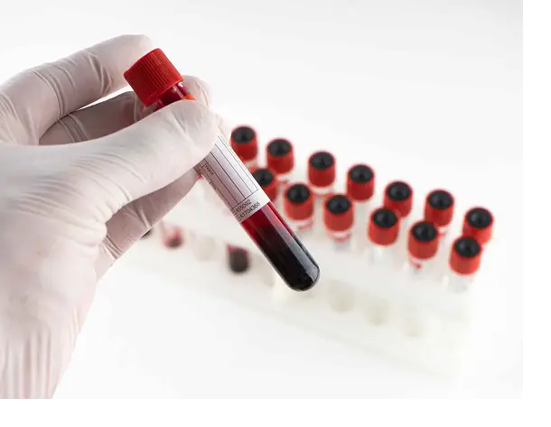 gallbladder-cance-eva Gallbladder cancer Evaluation