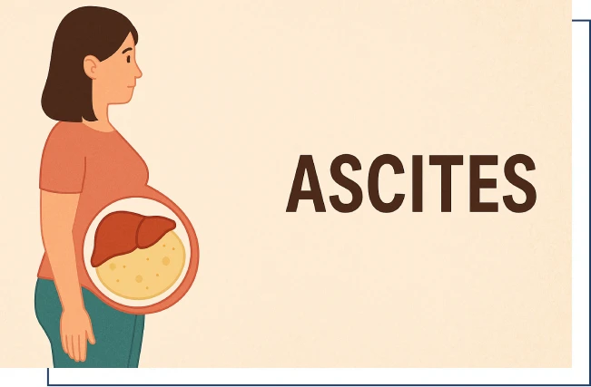 ascites-overview-img-one Overview