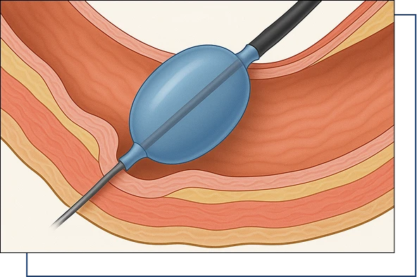 Achalasia Cardia management Achalasia Cardia management