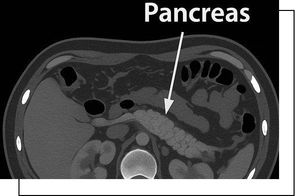 Autoimmune Pancreatitis Overview Autoimmune Pancreatitis Overview