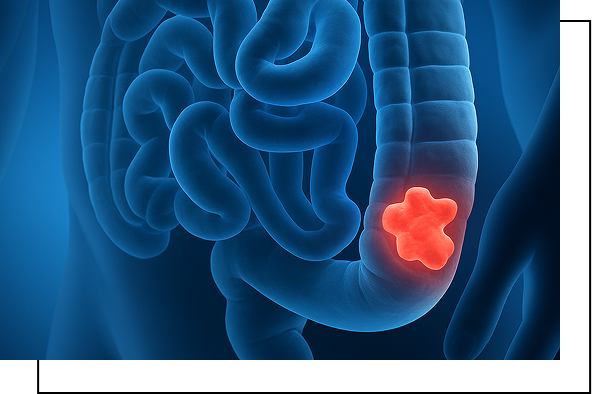 Colon Cancer overview image Colon Cancer overview image