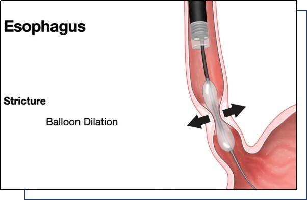 Strictures Dilation overview Strictures Dilation overview