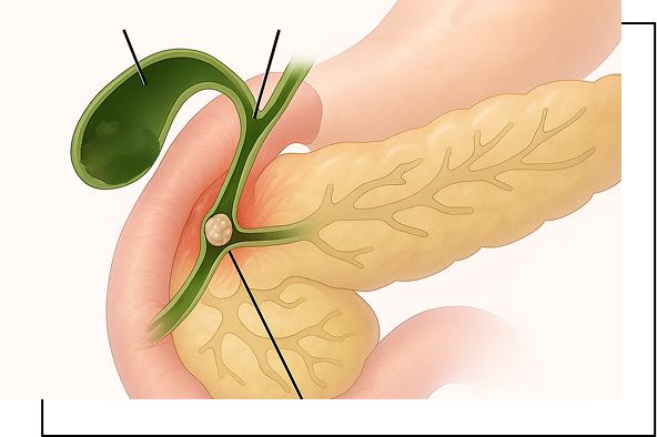 Bile Duct Stone Overview Bile Duct Stone Overview