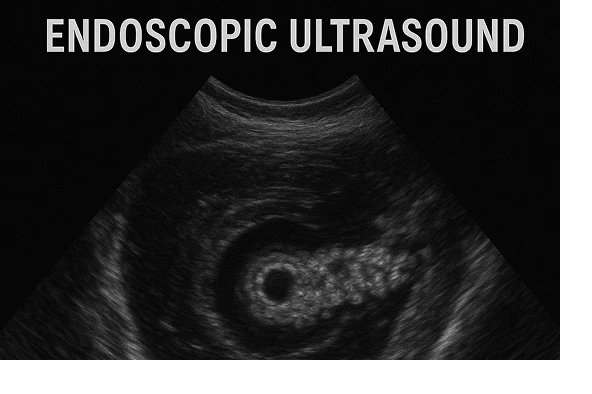 Chronic Pancreatitis Evaluation Chronic Pancreatitis Evaluation