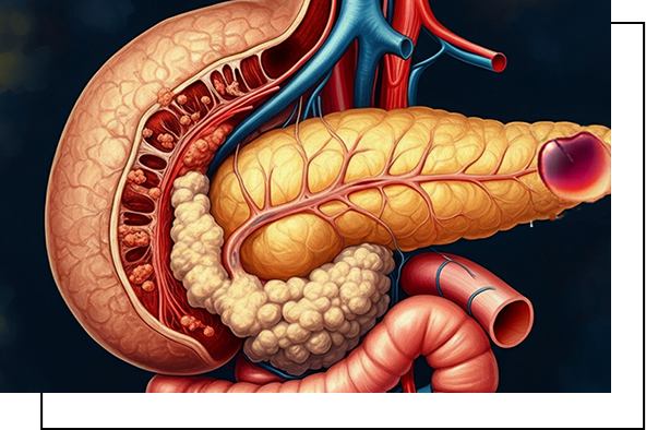 Cystic Neoplasm Of Pancreas overview Cystic Neoplasm Of Pancreas overview