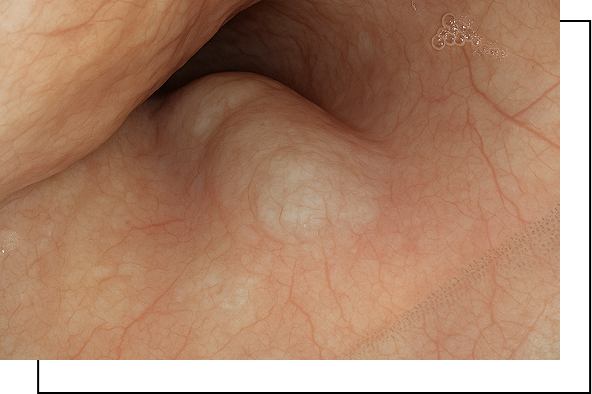 Esophageal Duplication Cyst overview Esophageal Duplication Cyst overview