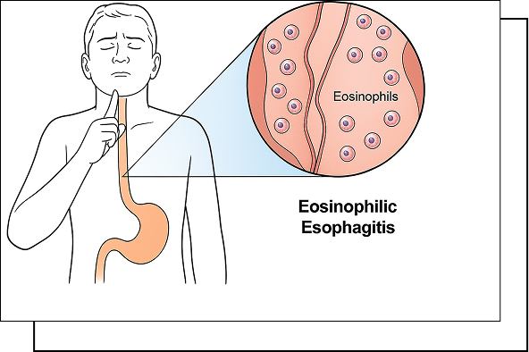 Eosinophilic Esophagitis overview Eosinophilic Esophagitis overview