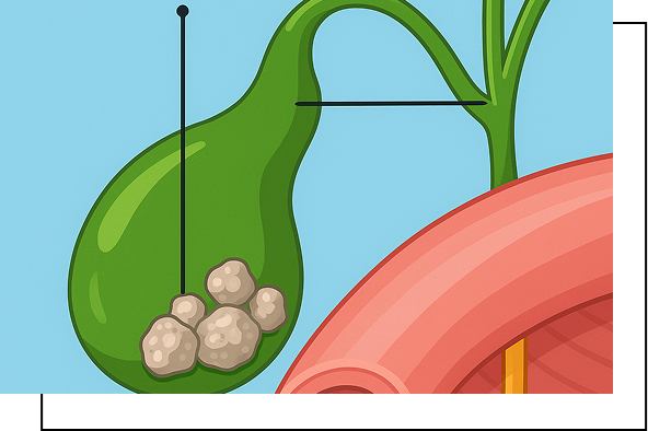 Gallstone Treatment Overview Gallstone Treatment Overview