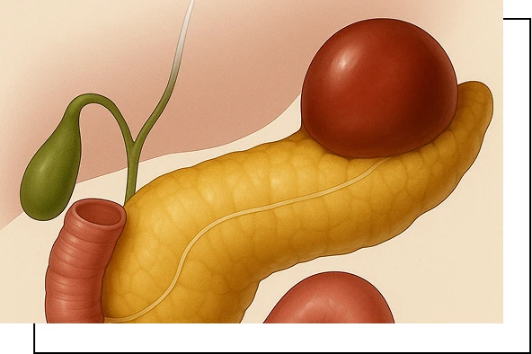 Pancreatic Pseudocyst Overview Pancreatic Pseudocyst Overview