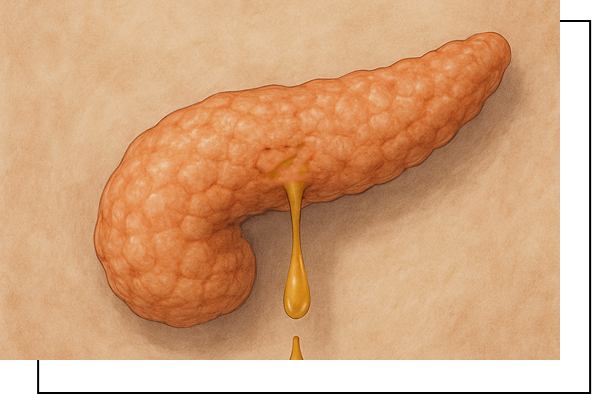 Pancreatic Leak Overview Pancreatic Leak Overview