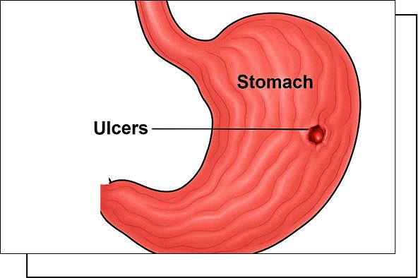 Peptic Gastric Ulcer overview Peptic Gastric Ulcer overview