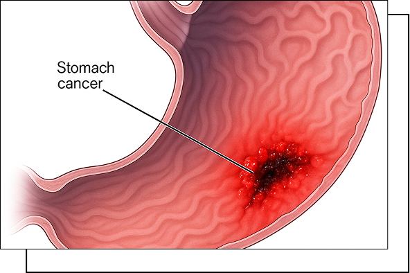 Stomach Cancer overview Stomach Cancer overview