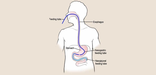 Feeding Tube Through Endoscopy in Kolkata Feeding Tube Through Endoscopy in Kolkata