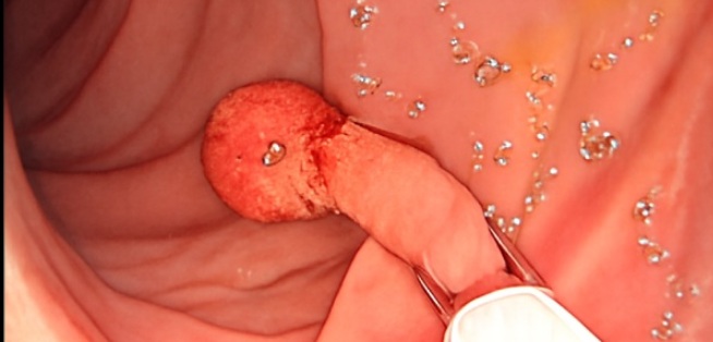 Polypectomy Polypectomy