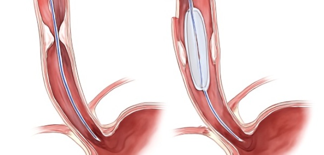 Oesophagus Narrowing Treatment in Kolkata Oesophagus Narrowing Treatment in Kolkata